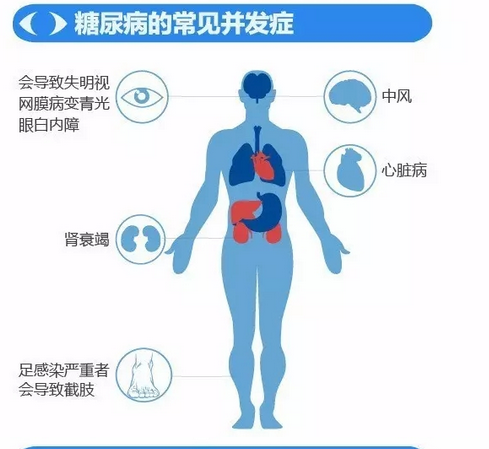 你造嗎？糖尿病晚期眼睛會致盲！