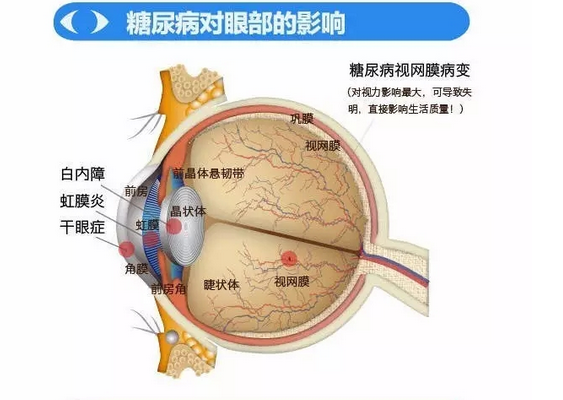 你造嗎？糖尿病晚期眼睛會致盲！