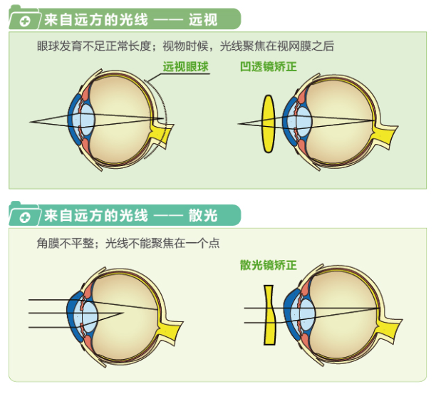 【看圖解】一張圖教你看懂近視、遠(yuǎn)視和散光